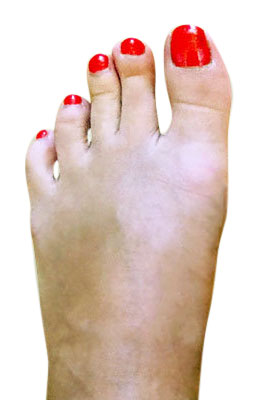 Bunion Correction with Lapidus Procedure after