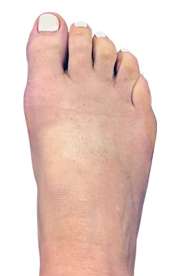 miniBunion™ Minimally Invasive Bunion Surgery, Hammertoe Correction and Plantar Plate Repair after