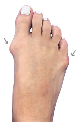 miniBunion™ Minimally Invasive Bunion Surgery, Hammertoe Correction and Plantar Plate Repair before