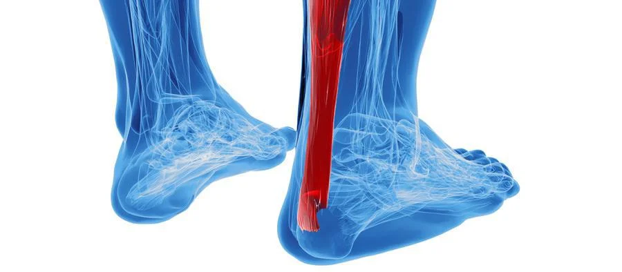 achilles tendonitis