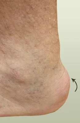 Achilles Spur Surgery before