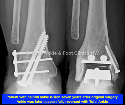 Ankle Fusion Reversal