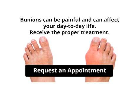 Are Bunions Affecting Your Everyday Life