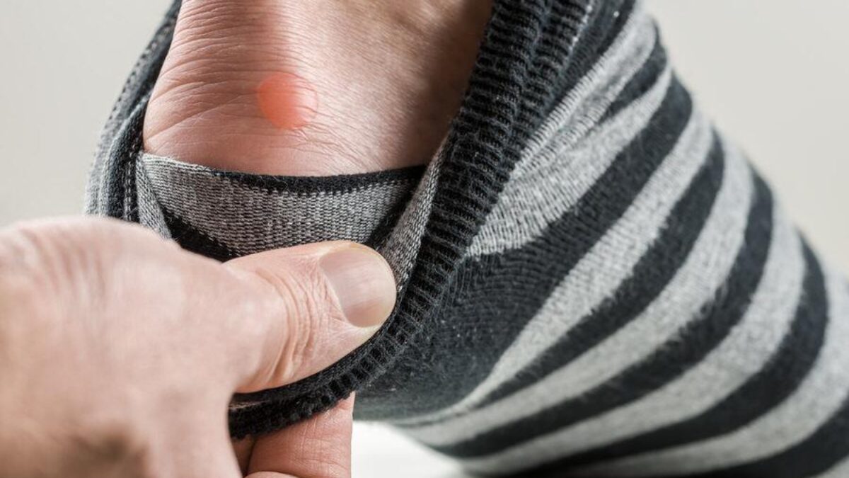 Friction Burn: Causes and How to Treat Them