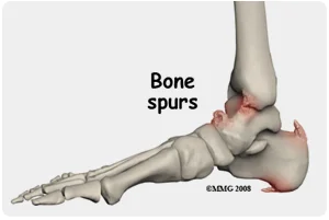 Bone Spur Treatment