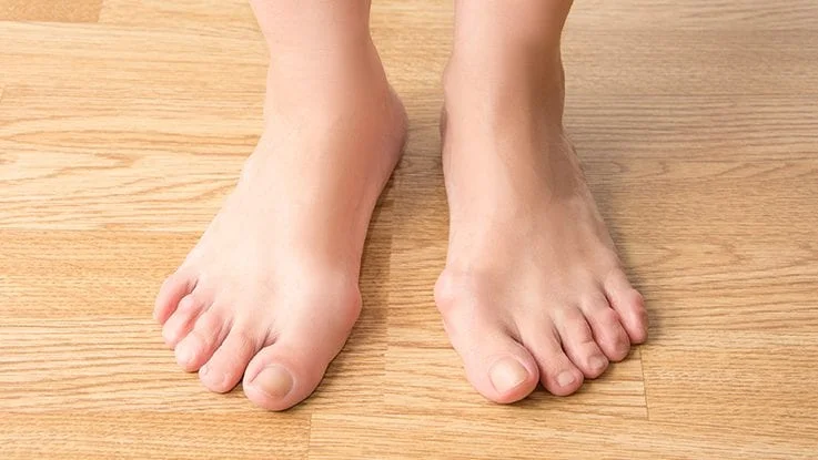Weil Foot & Ankle Institute - Bunion Treatment