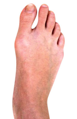 Osteotomy Bunion Surgery after