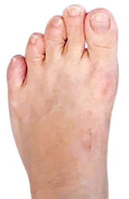 Bunion Revision Surgery after