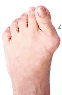 Bunion Revision Surgery before
