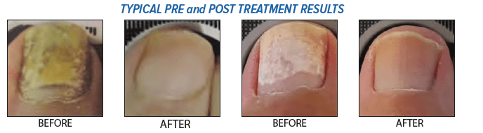 Fungal nails before and after photo