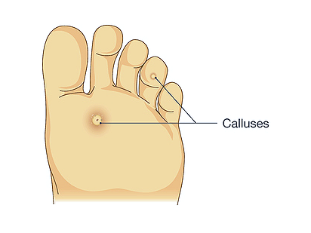 Calluses and Corns  Foot and Ankle Specialists