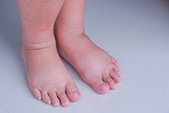 Causes of Swelling in Feet and Ankles