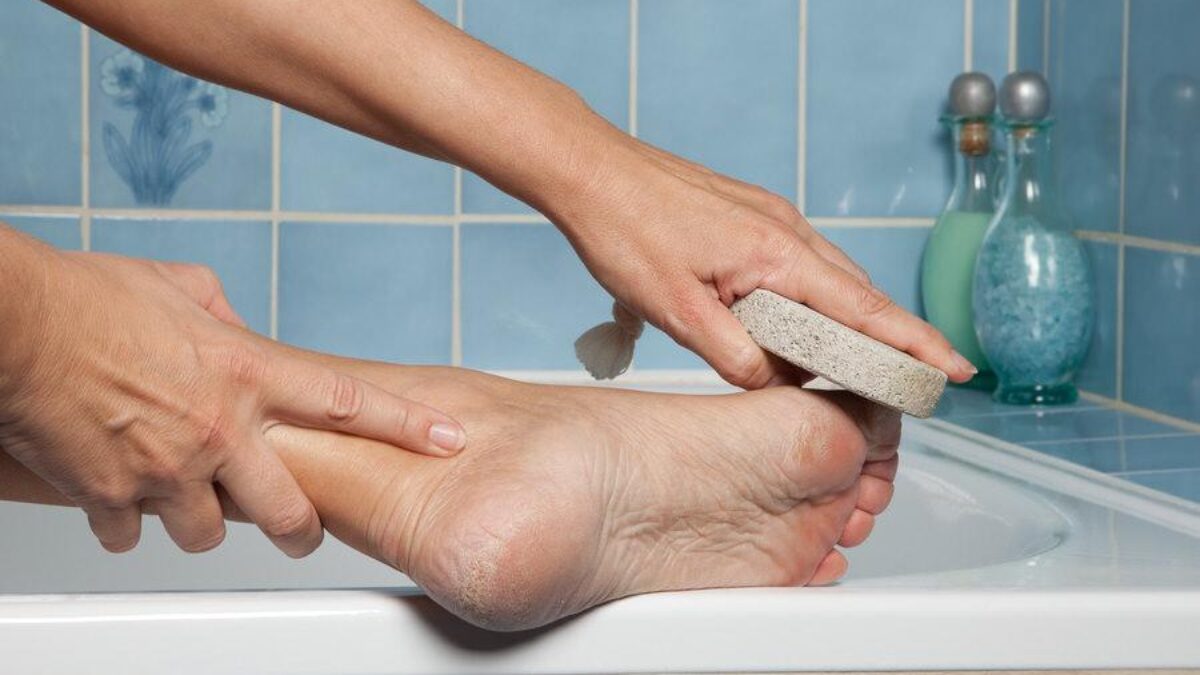 When to Consider Foot Callus Removal