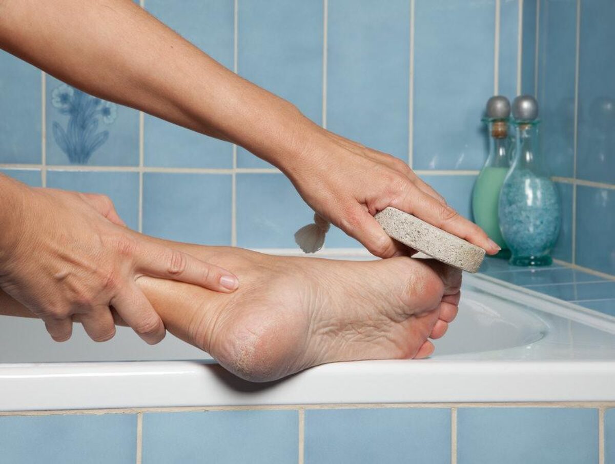 callus removal, Hand&Foot Aesthetic Clinic