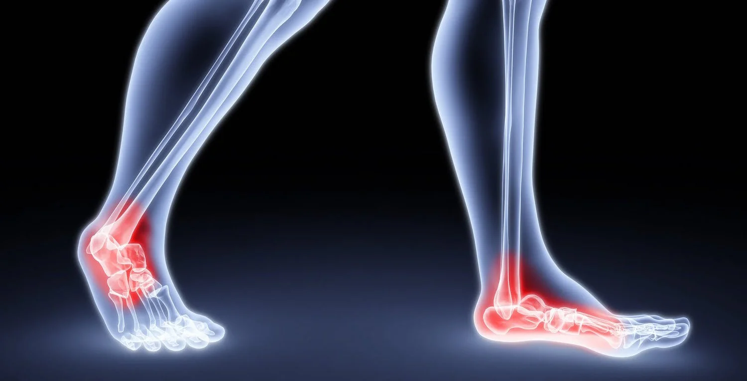 Could That Pain in Your Foot Be Arthritis?