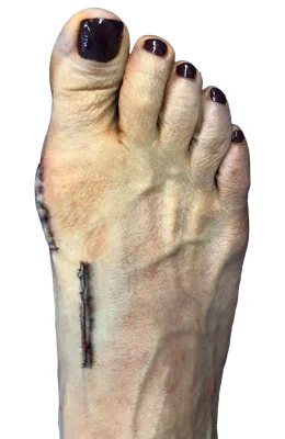 Lapidus Forever Bunionectomy™ and Hamertoe Correction after