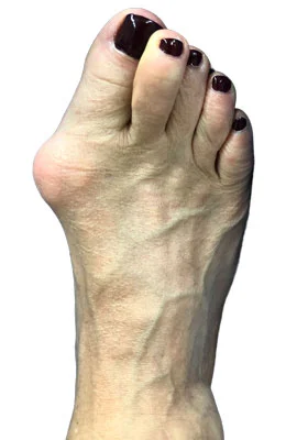 Lapidus Forever Bunionectomy™ and Hamertoe Correction before
