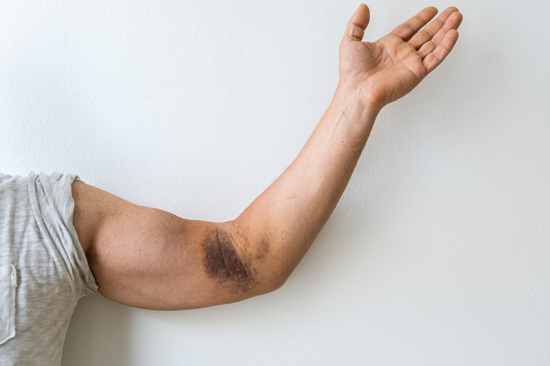 Distal Biceps Tendon Rupture