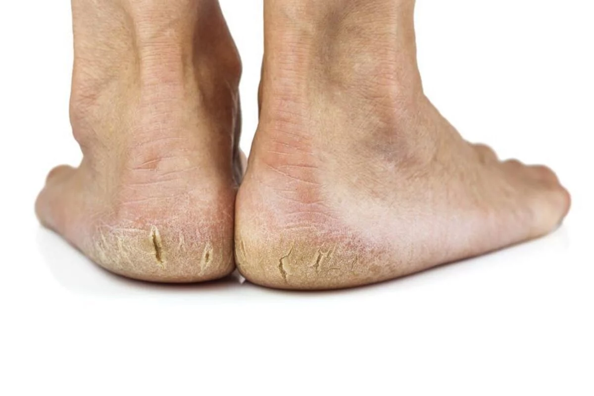 crusty feet
