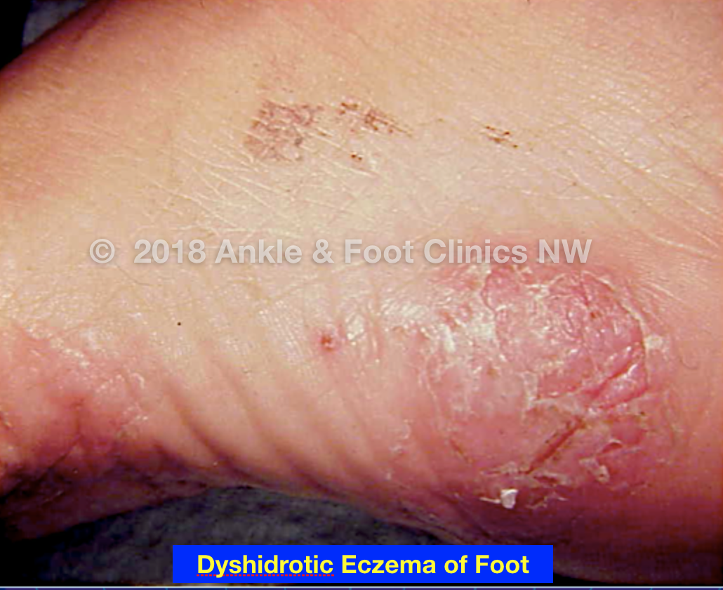 Dyshidrotic Eczema On Feet And Toes