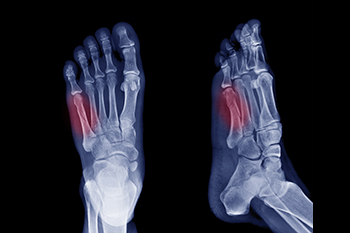 Facts About a Jones Fracture in the Foot