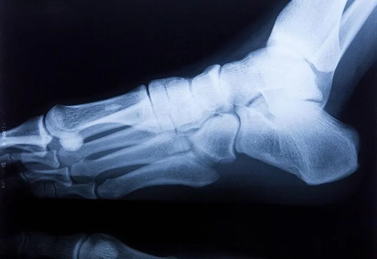 Foot and Ankle Fractures - How Can a Podiatrist Help?