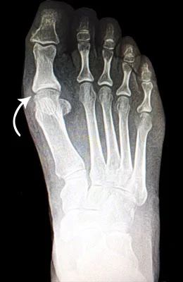 Great Toe Fusion before