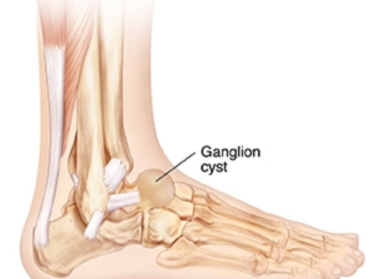 Ganglion Cyst Removal From Foot Draining A Ganglion Cyst Ganglion Cyst