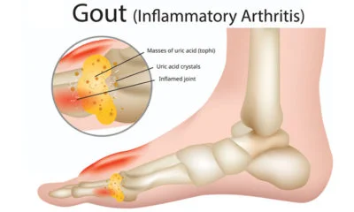 Gout treatment