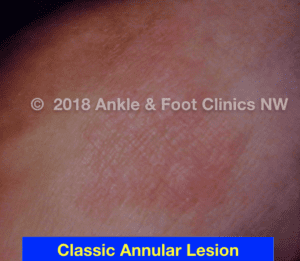 Granuloma Annulare | Integrative Foot & Ankle Centers of Washington