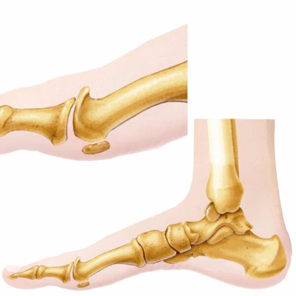 Hallux Rigidus | Definition and Treatment