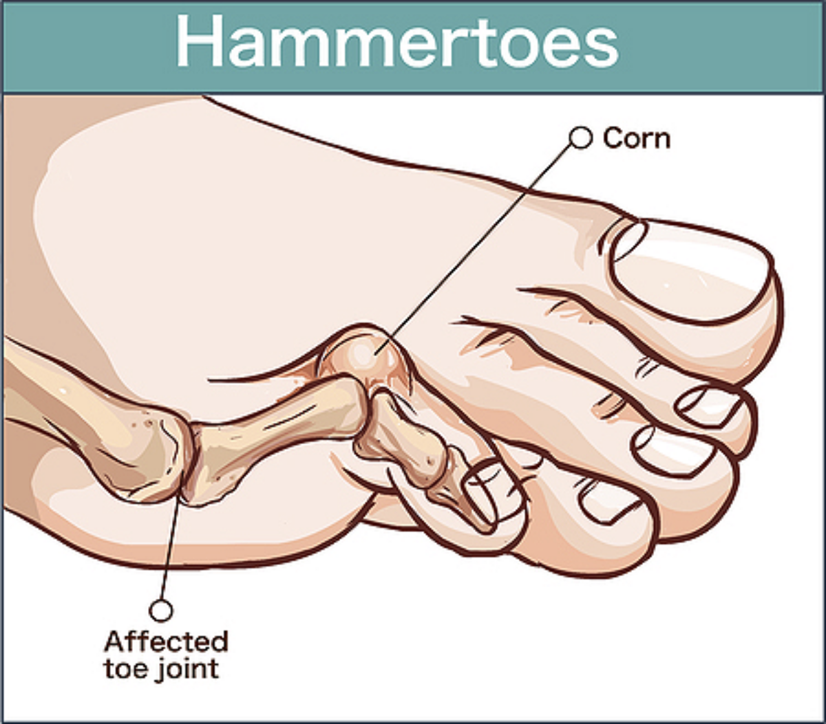 What Does a Hammer Toe Look Like & What Causes It?