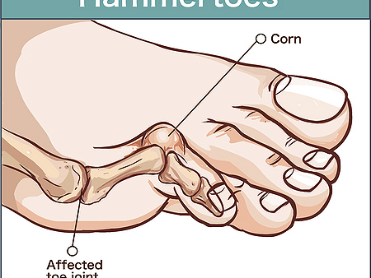 Hammer Toe: Causes, Symptoms And Treatment