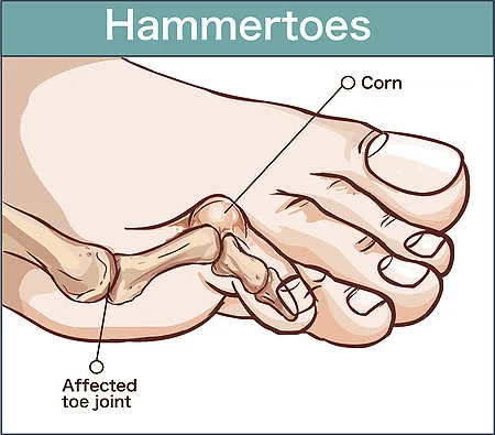 Hammertoe