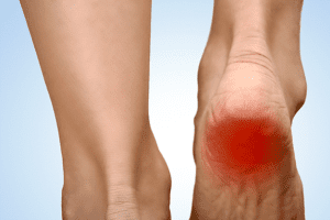 Heel Pain and Spurs