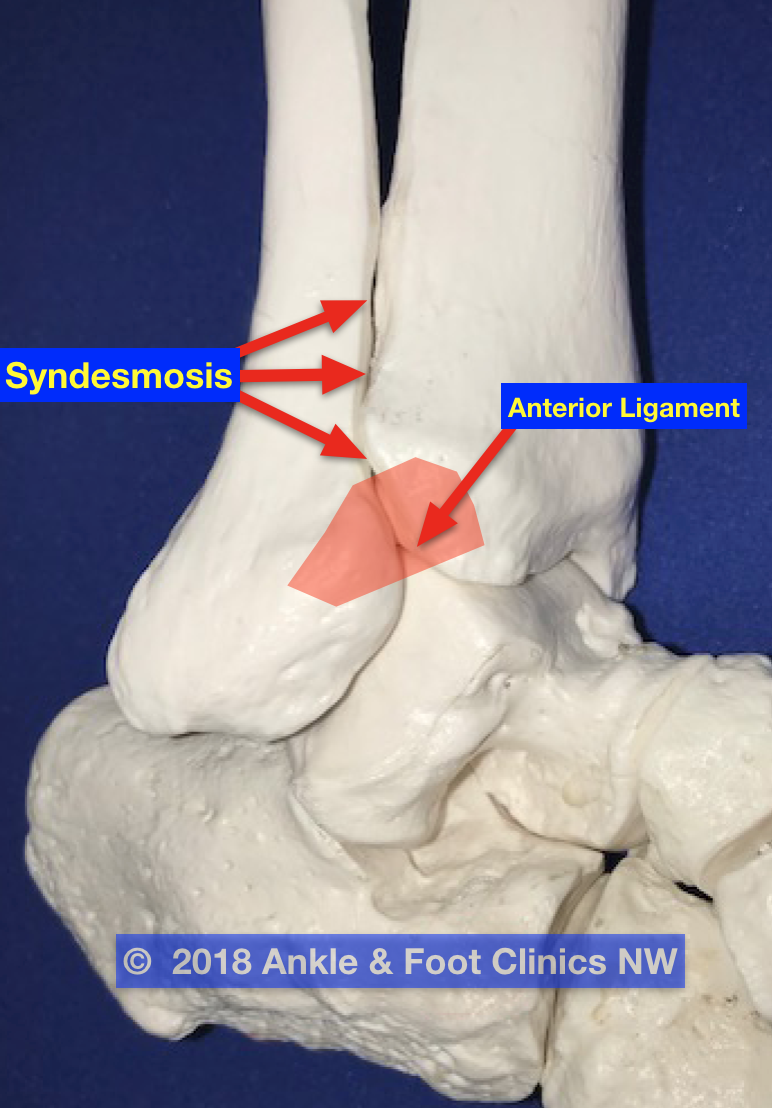 High Ankle Sprain  Integrative Foot & Ankle Centers of Washington