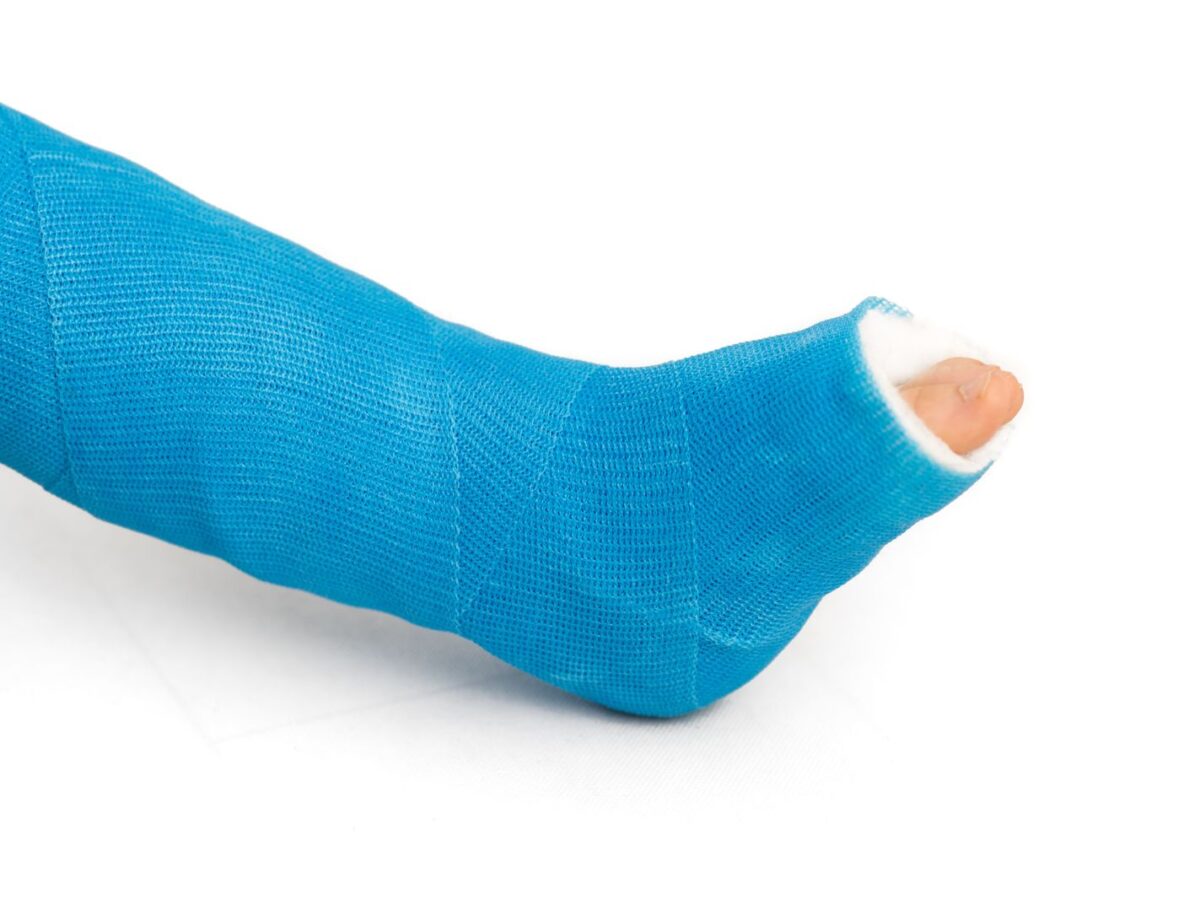 How Long Will My Broken Foot Be Casted? A Guide to Recovery and Treatment