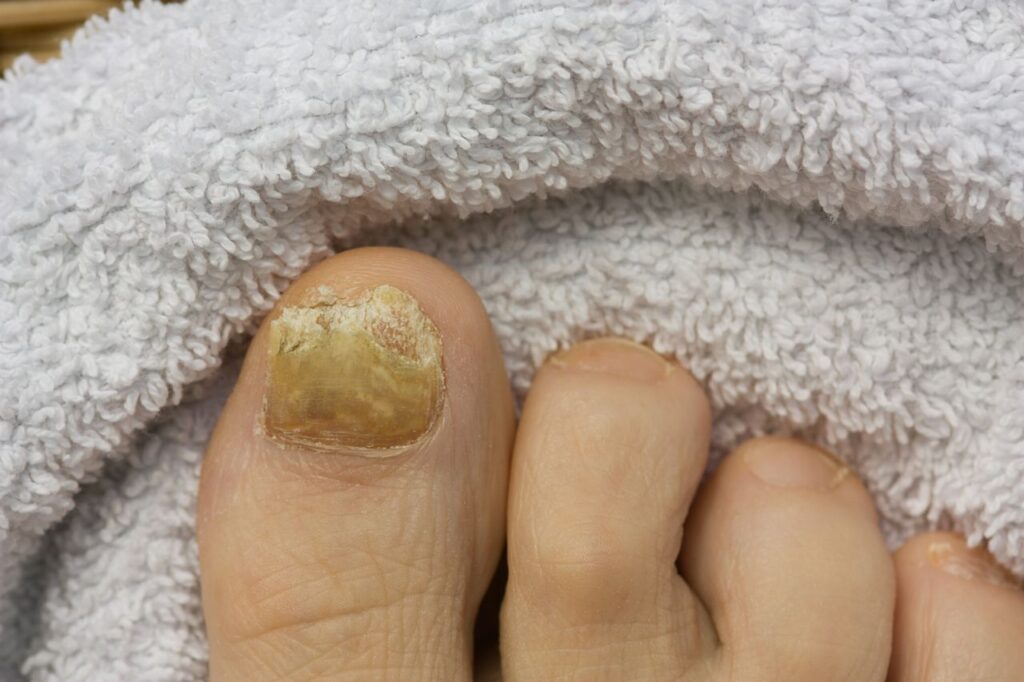 If I have my fungal toenail removed, will the fungal nail grow back
