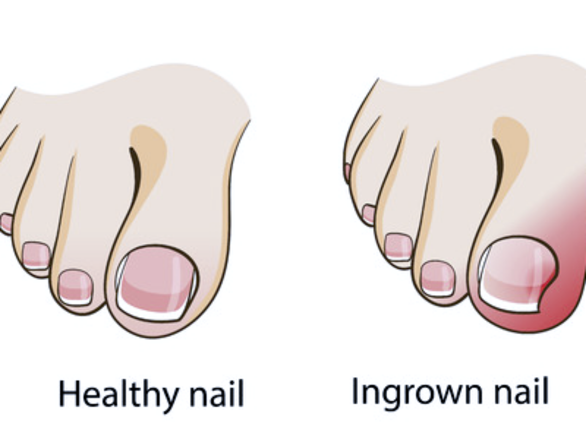 Ingrown Toenails  Advanced Foot & Ankle Care Specialists