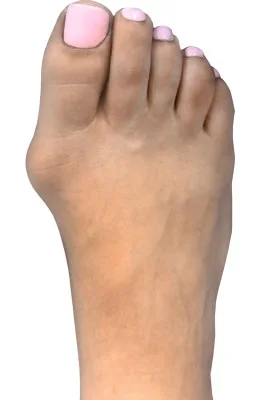 Lapidus Forever Bunionectomy™ before