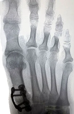 Lapiplasty Bunion Surgery after