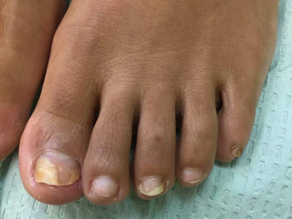 Fungal Thickened Nails – Santa Monica Podiatry