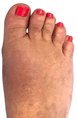 MinVasive™ Minimally invasive Bunion Surgery featuring the CrossRoads miniBunion™ System after