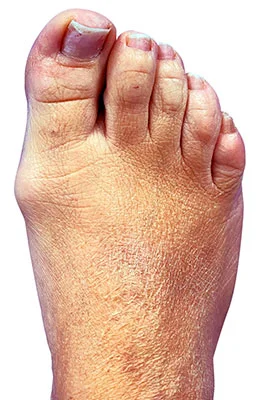 MinVasive™ Minimally invasive Bunion Surgery featuring the CrossRoads miniBunion™ System before