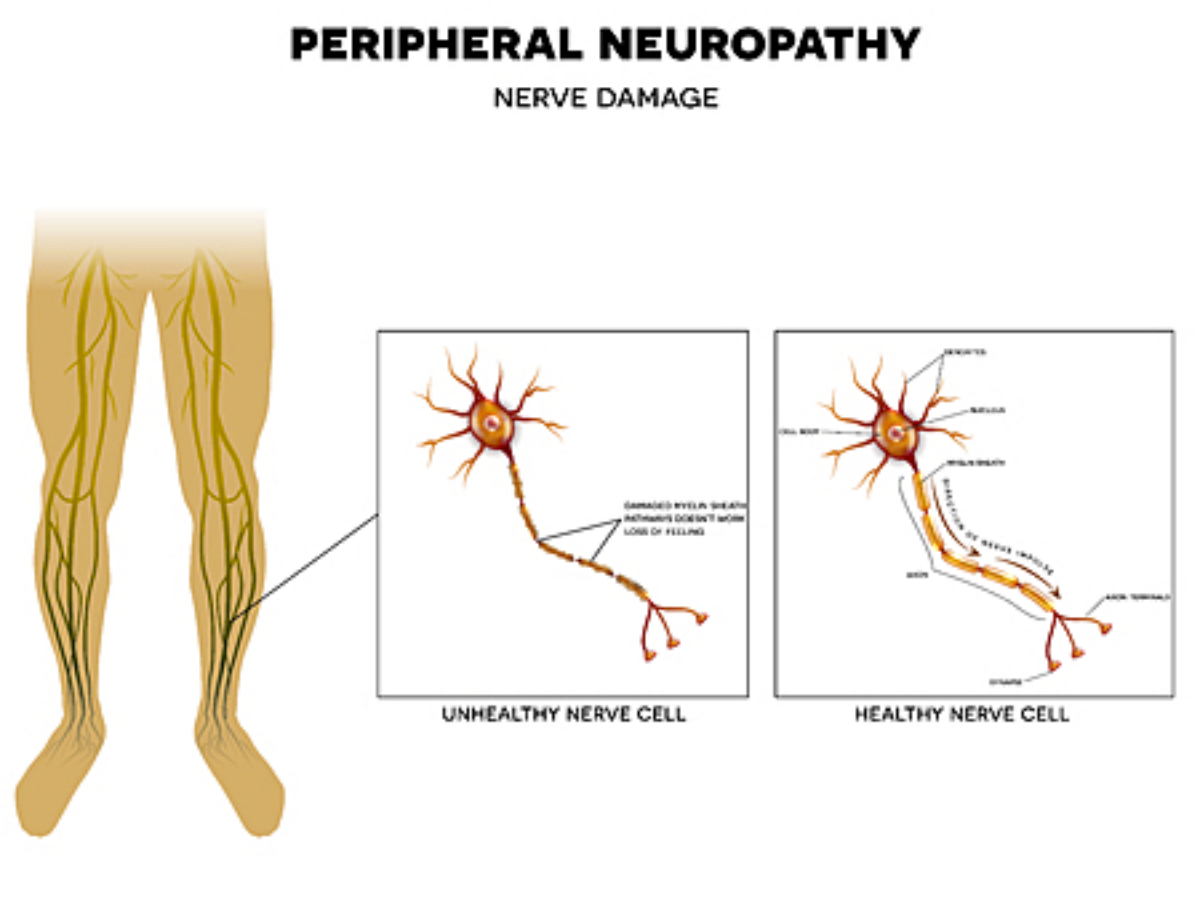 Neuropathy   Foot and Ankle Specialists