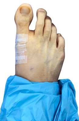Osteotomy Bunionectomy after