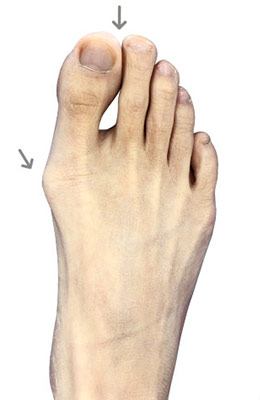 Osteotomy Bunionectomy before