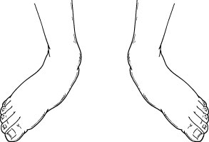 Pediatric Flatfoot (Children’s Flatfoot)