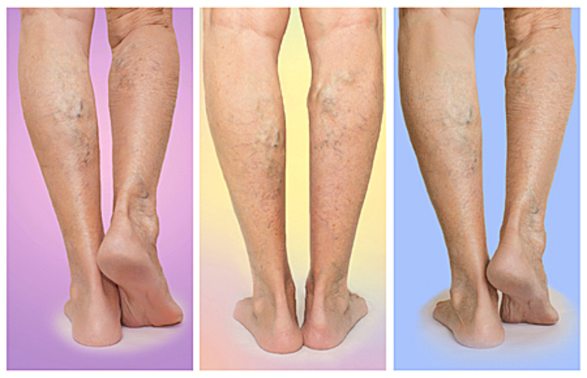 Vascular Disease of the Feet | Center for Vascular Medicine