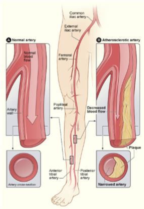 Peripheral Vascular Disease